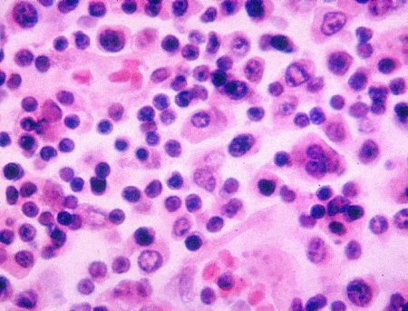 Typhoid Fever (Salmonella Typhi)